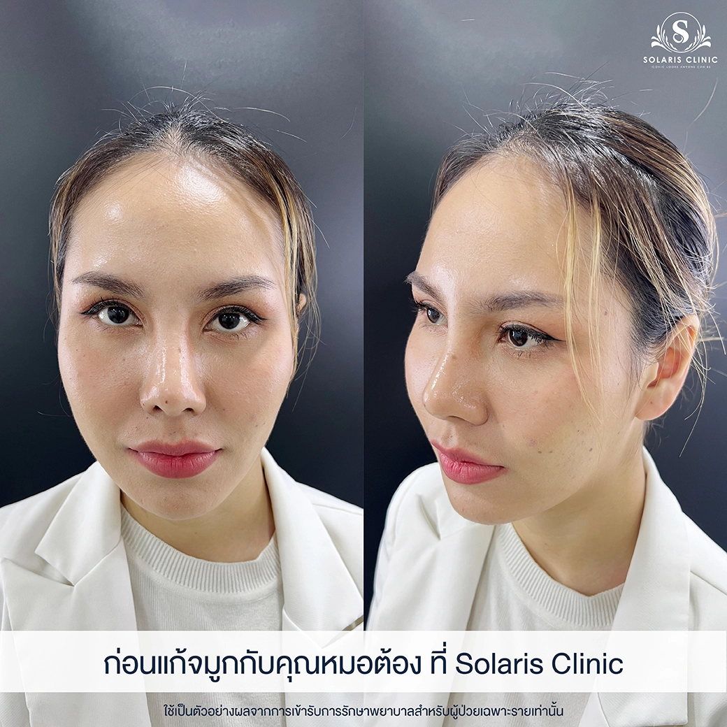 จมูกพังมาก แก้ที่ไหนดี