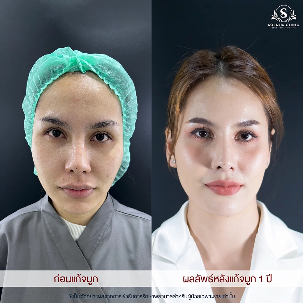 ทำจมูกที่ไหนดี โคราช