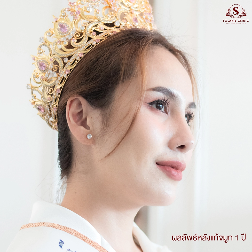 จมูกทรงนางงาม