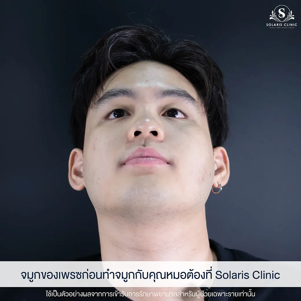 คลีนิคเสริมจมูก ใกล้ฉัน