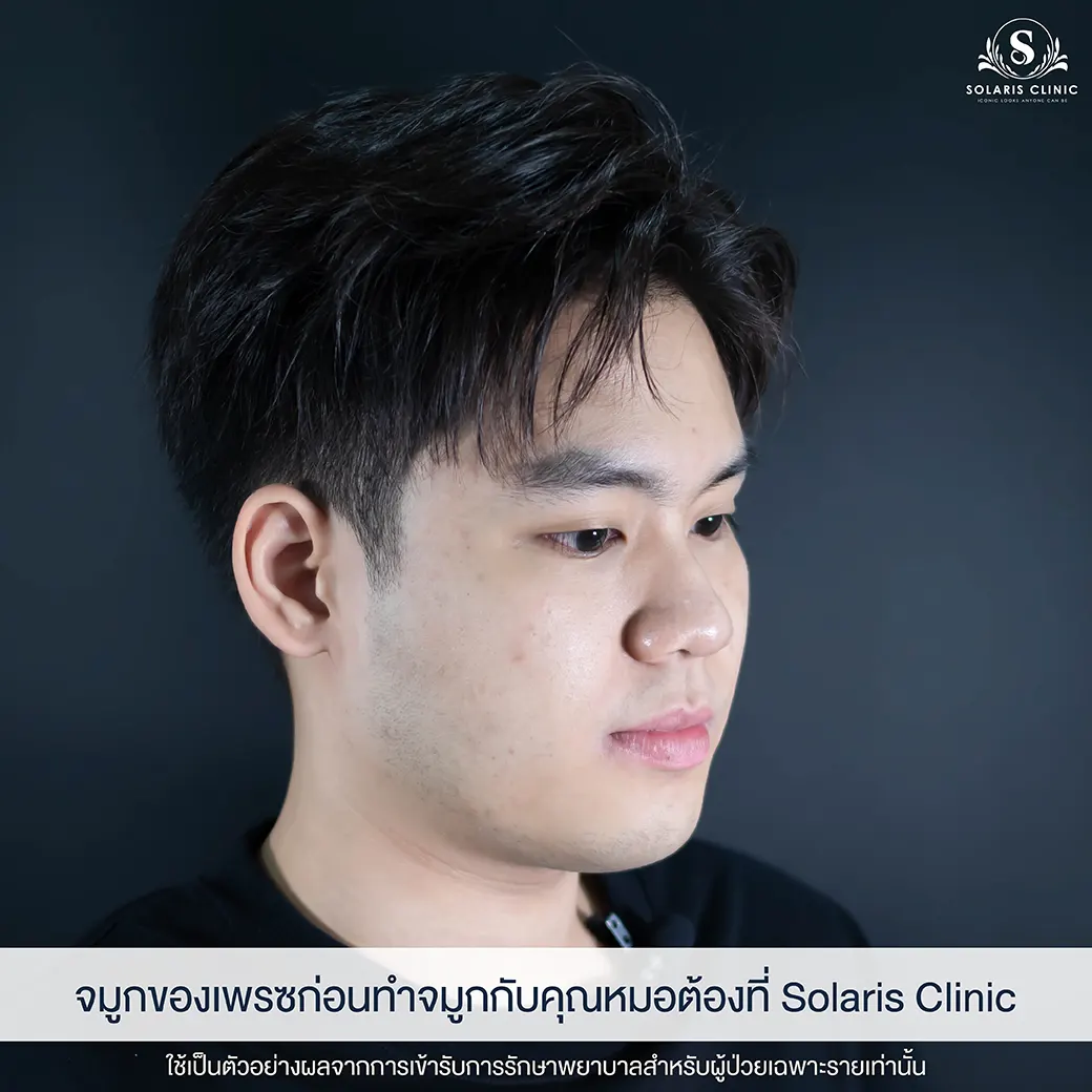 เสริมดั้ง ขอนแก่น