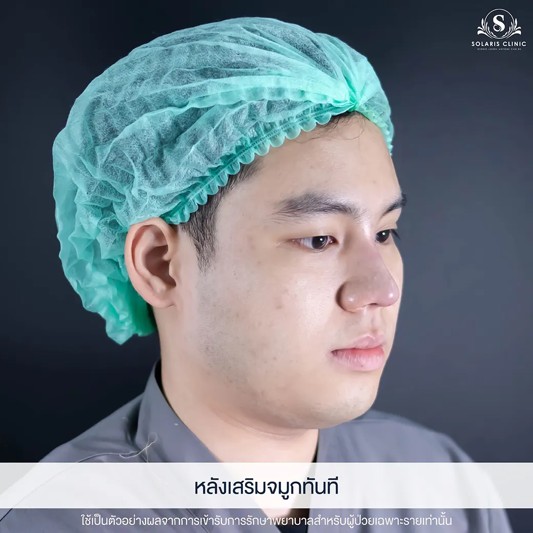 เสริมดั้ง