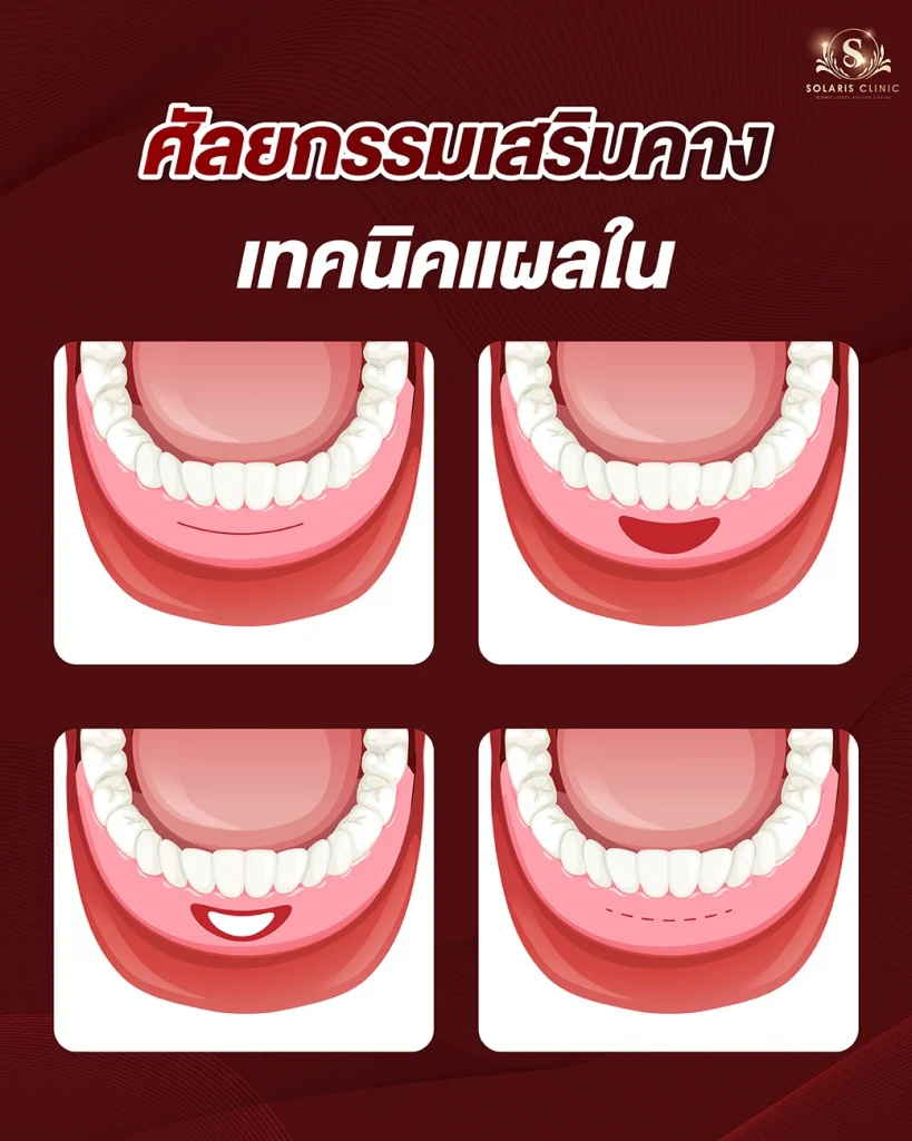 เสริมคาง แผลในดีไหม