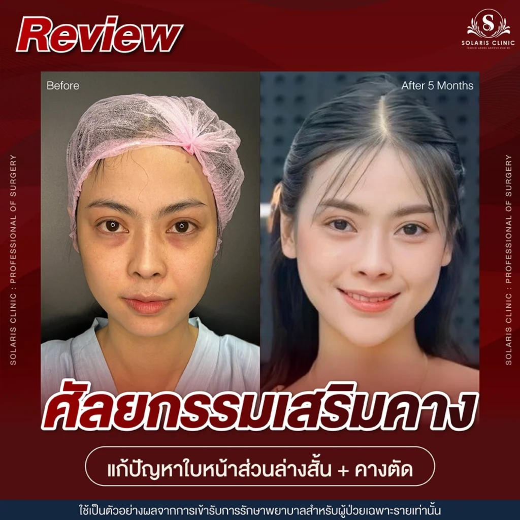 review เสริมคาง