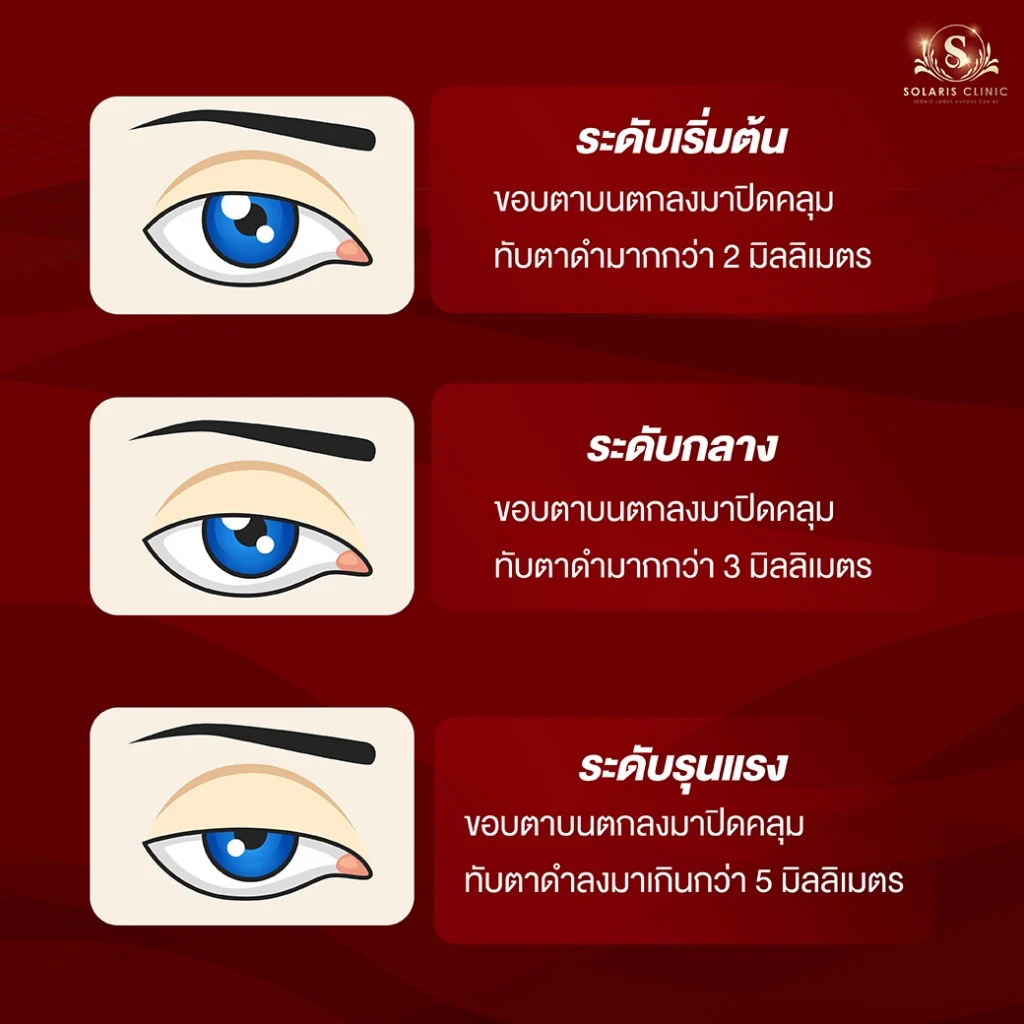 กล้ามเนื้อตาอ่อนแรง