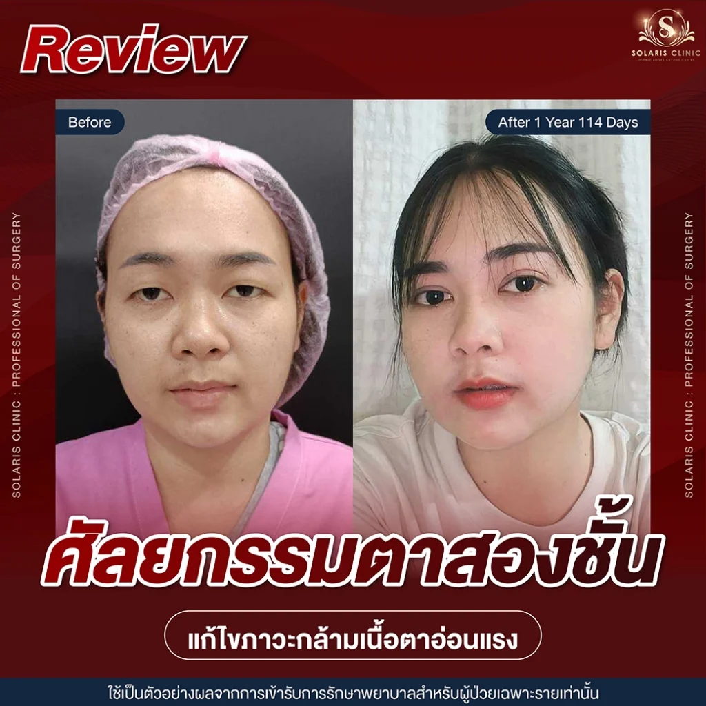 รีวิวกล้ามเนื้อตาอ่อนแรง