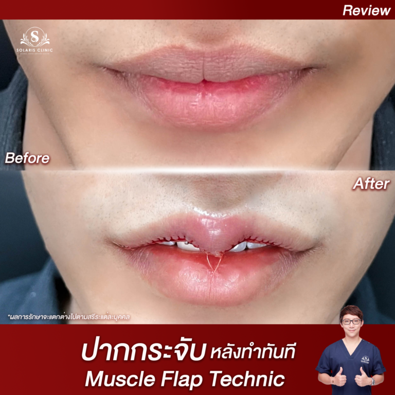 ปากกระจับ หลังทำทันที Muscle Flap Technic