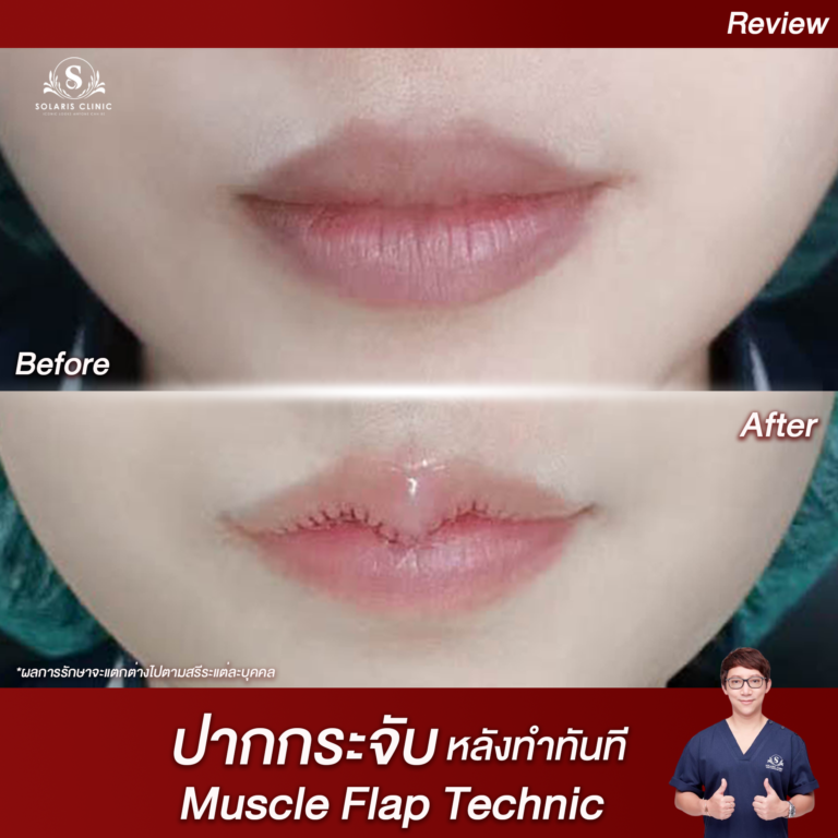 ปากหลังทำทันที 2