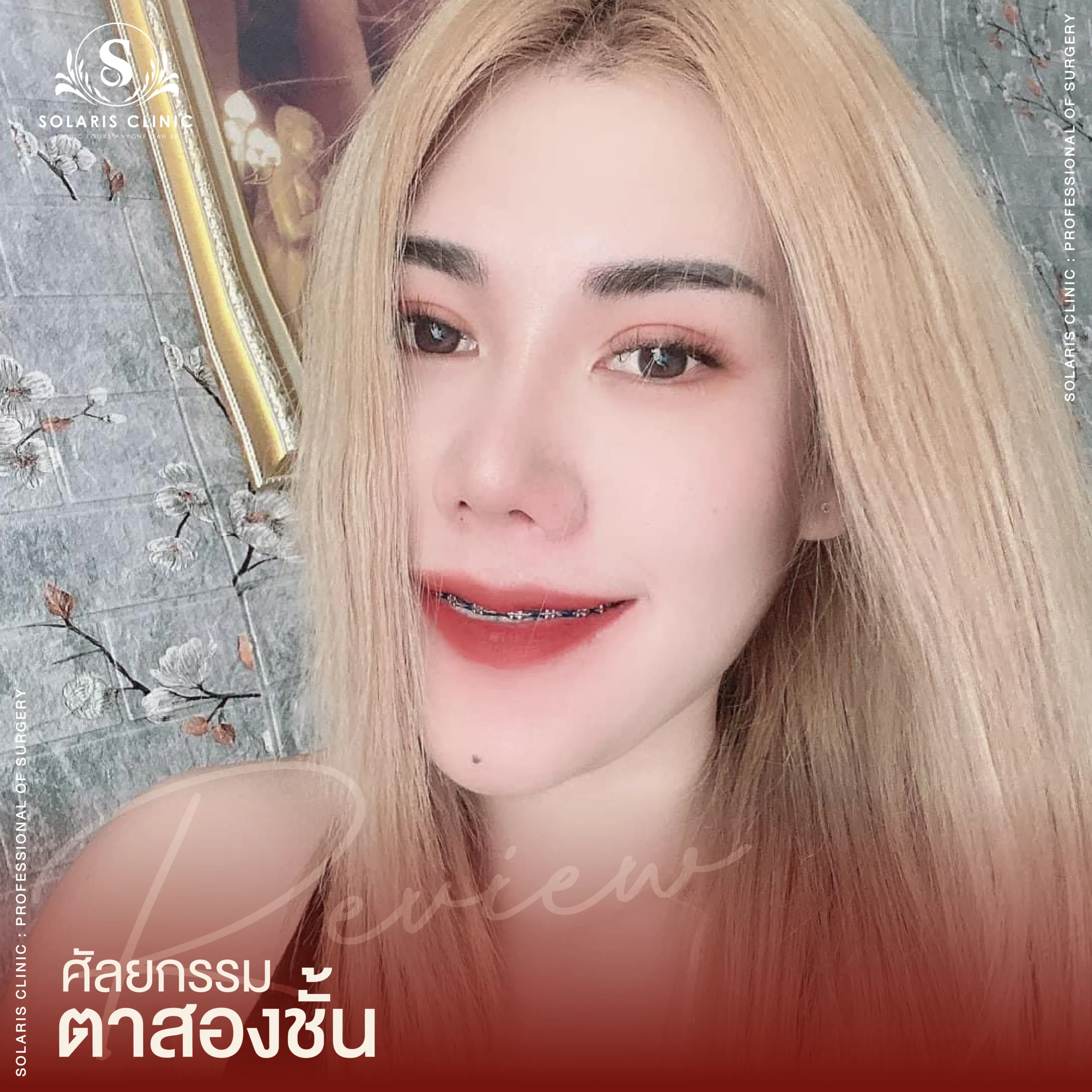 Review ศัลยกรรมตาสองชั้น-01_6