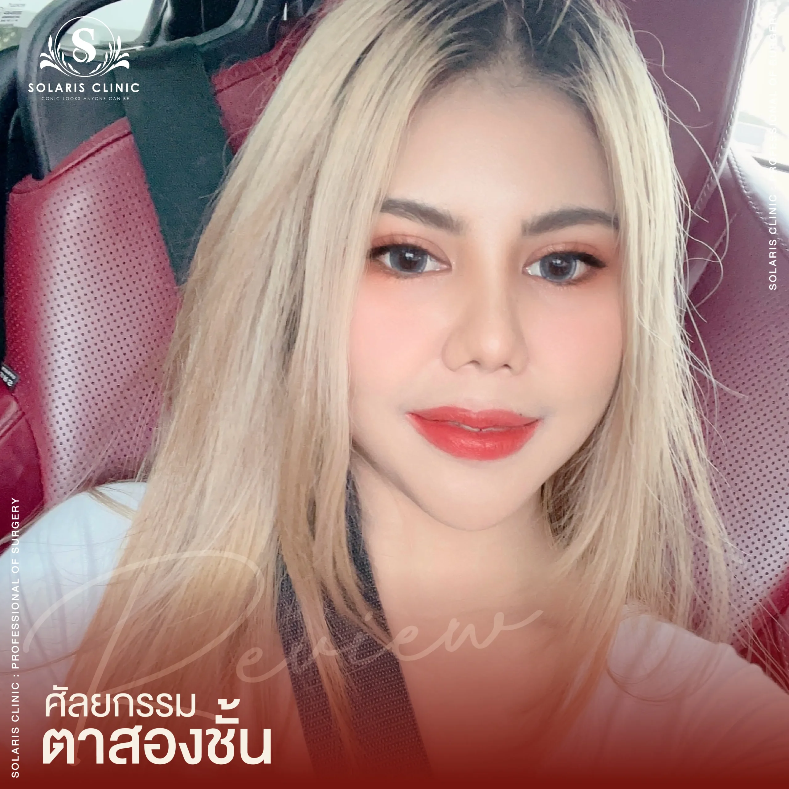 Review ศัลยกรรมตาสองชั้น-03_8