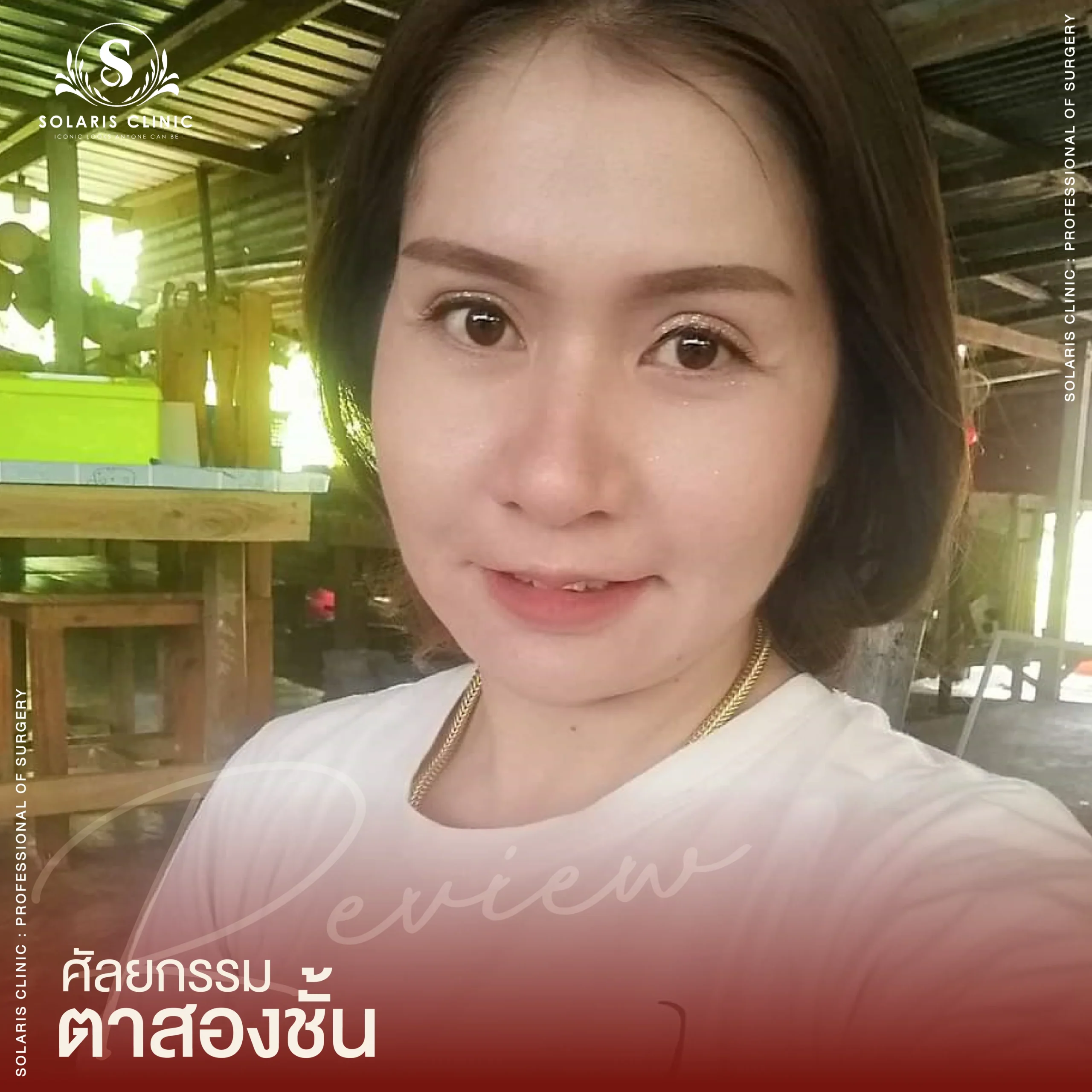 Review ศัลยกรรมตาสองชั้น-09_14