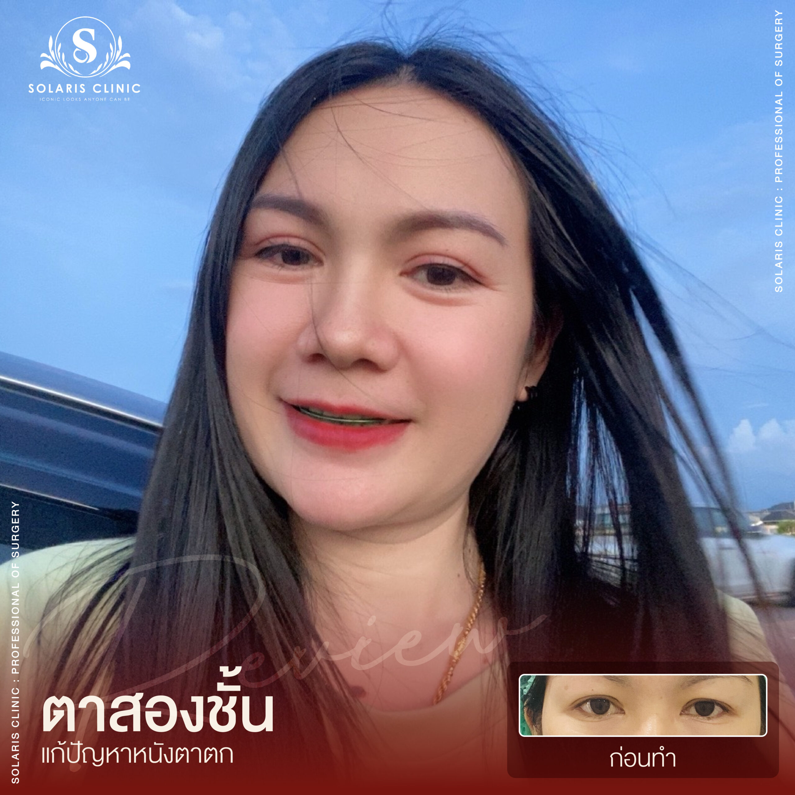 รีวิวหนังตาตก -03