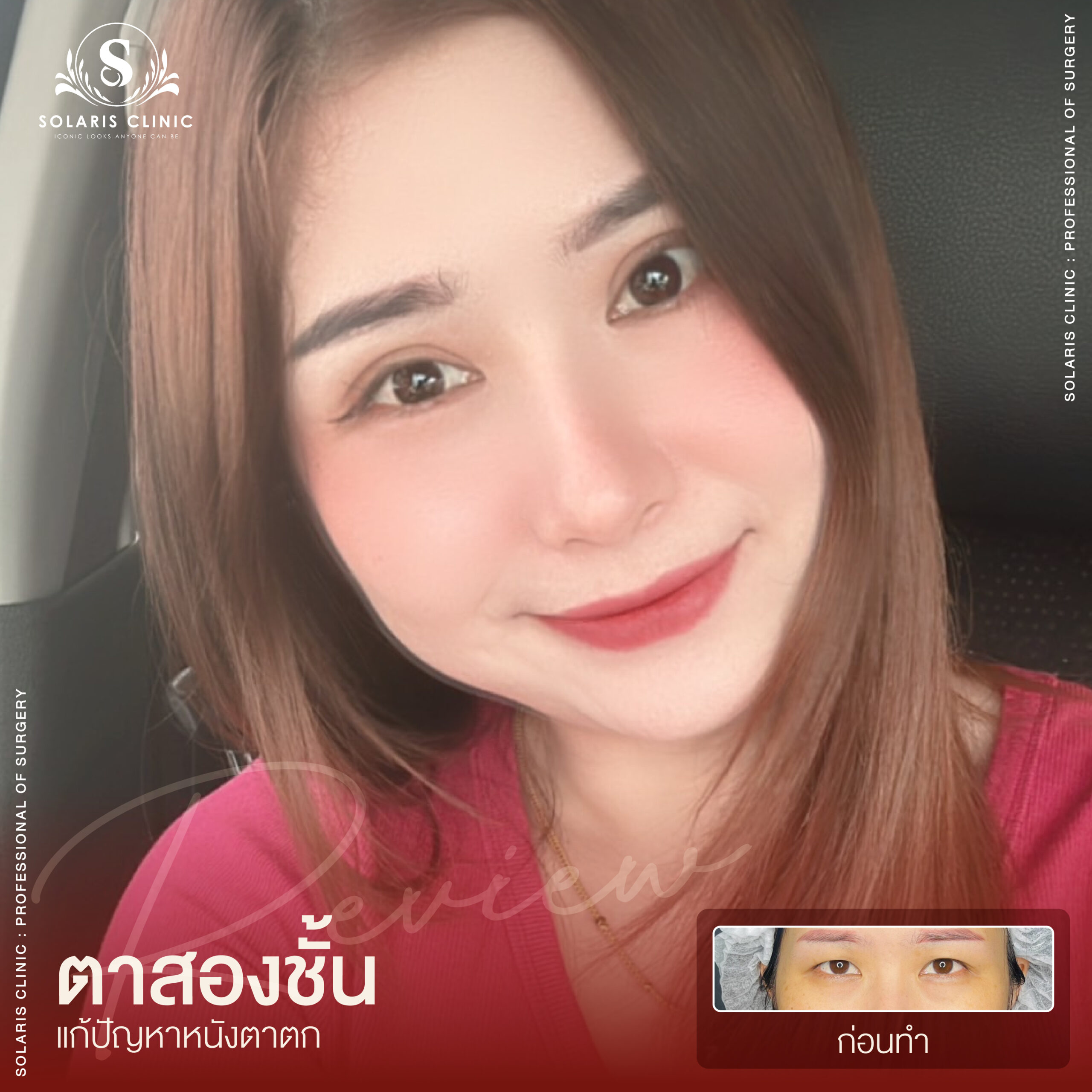 รีวิวหนังตาตก -04