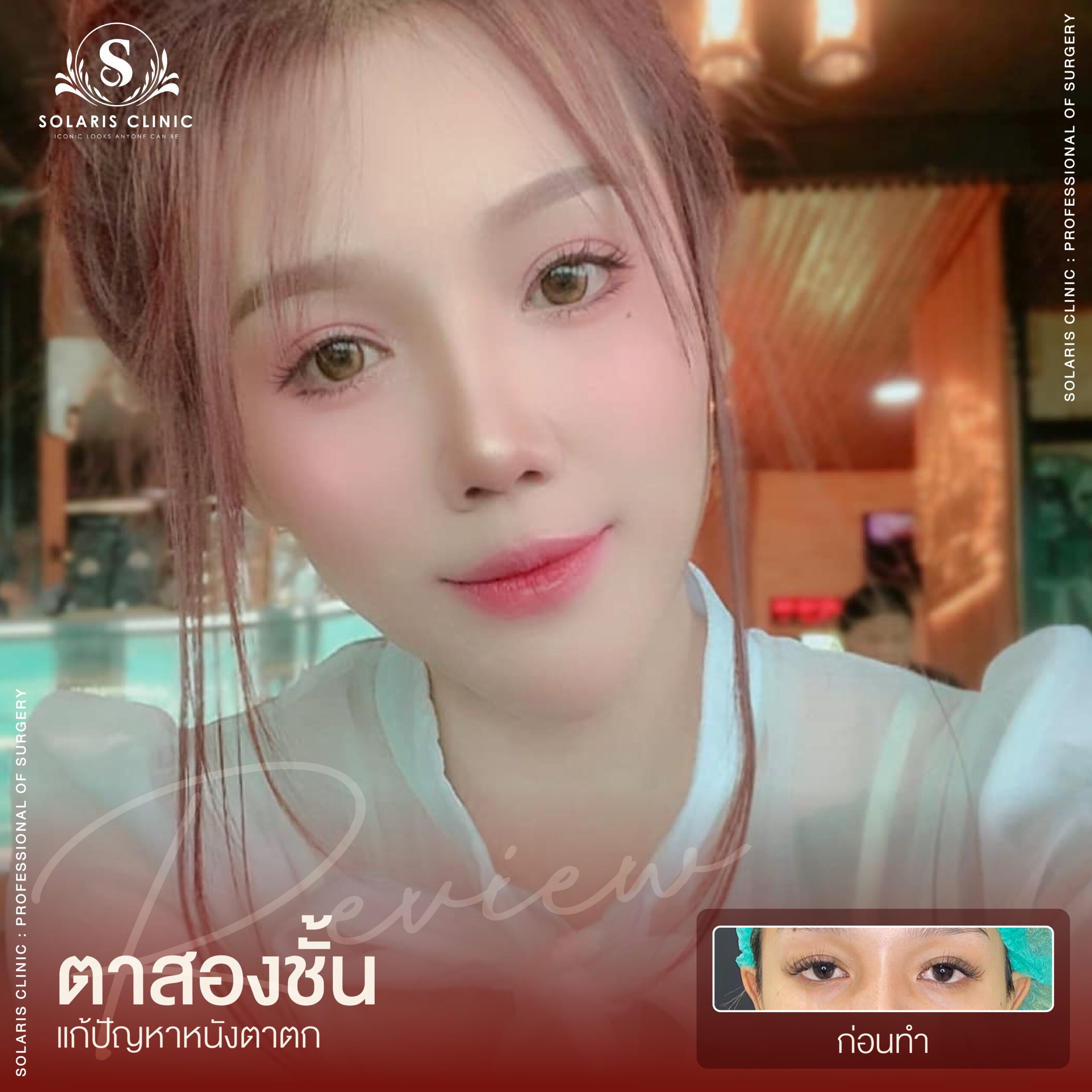 รีวิวหนังตาตก -05