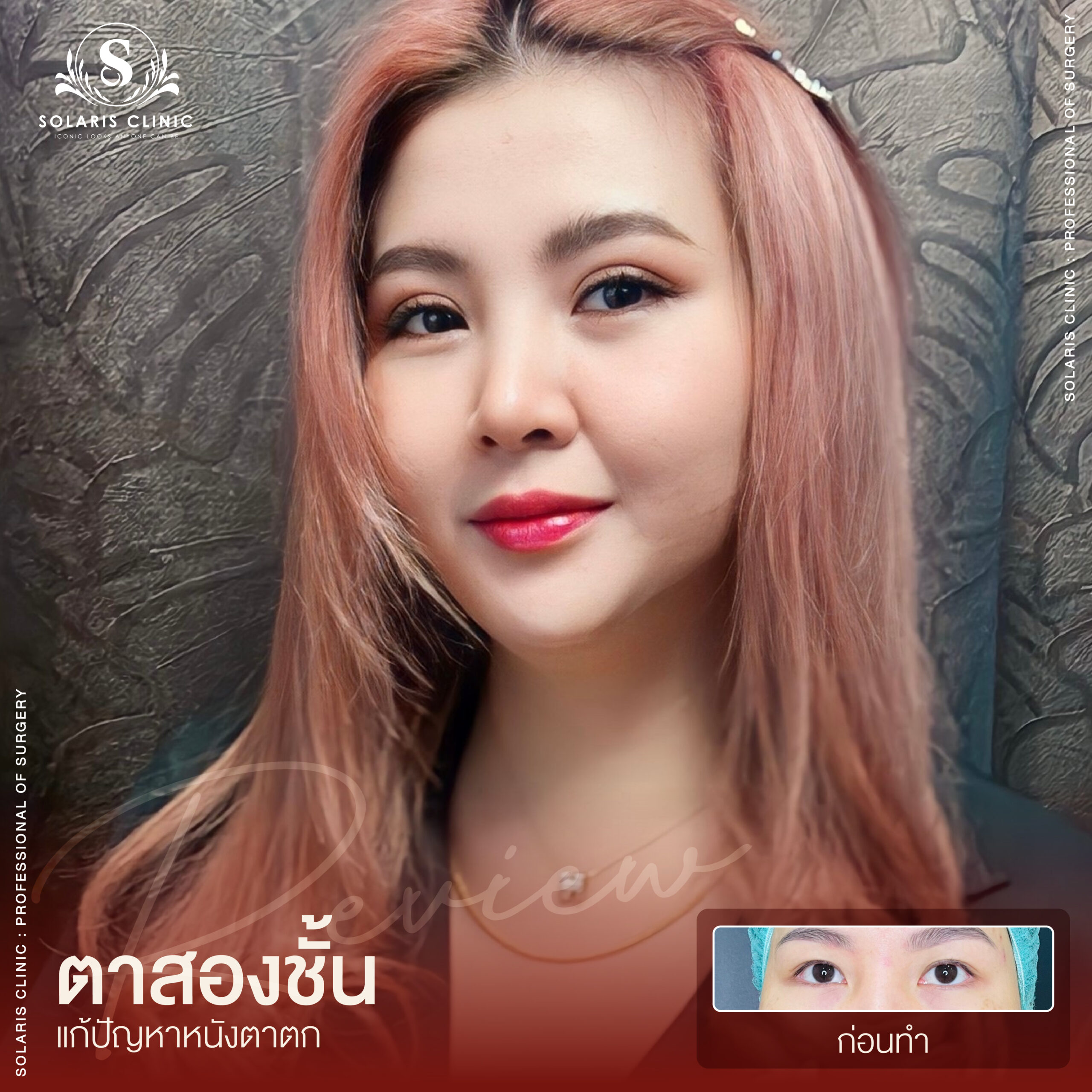 รีวิวหนังตาตก -06