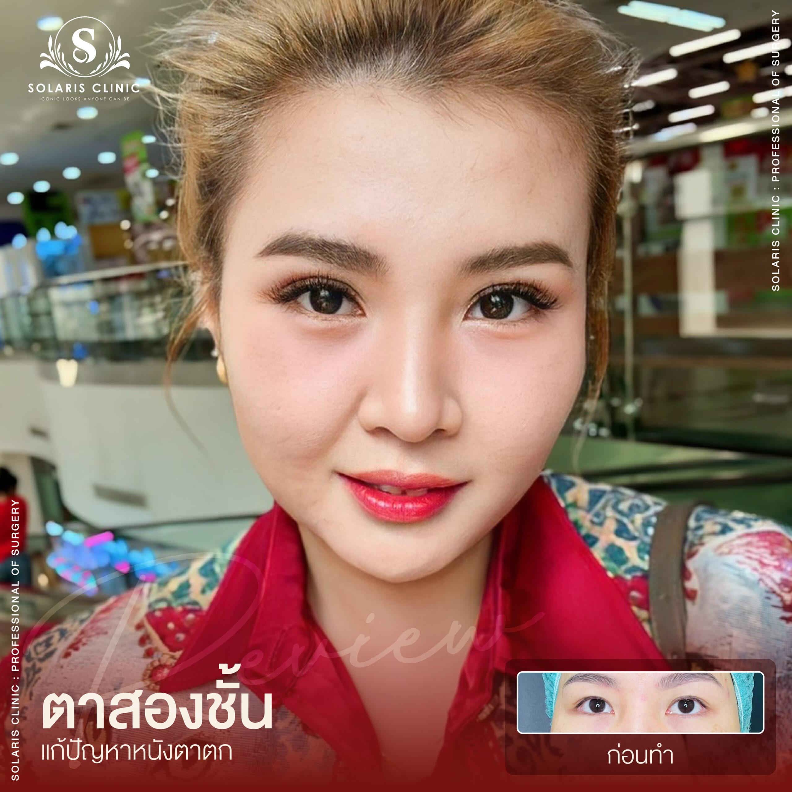รีวิวหนังตาตก -07