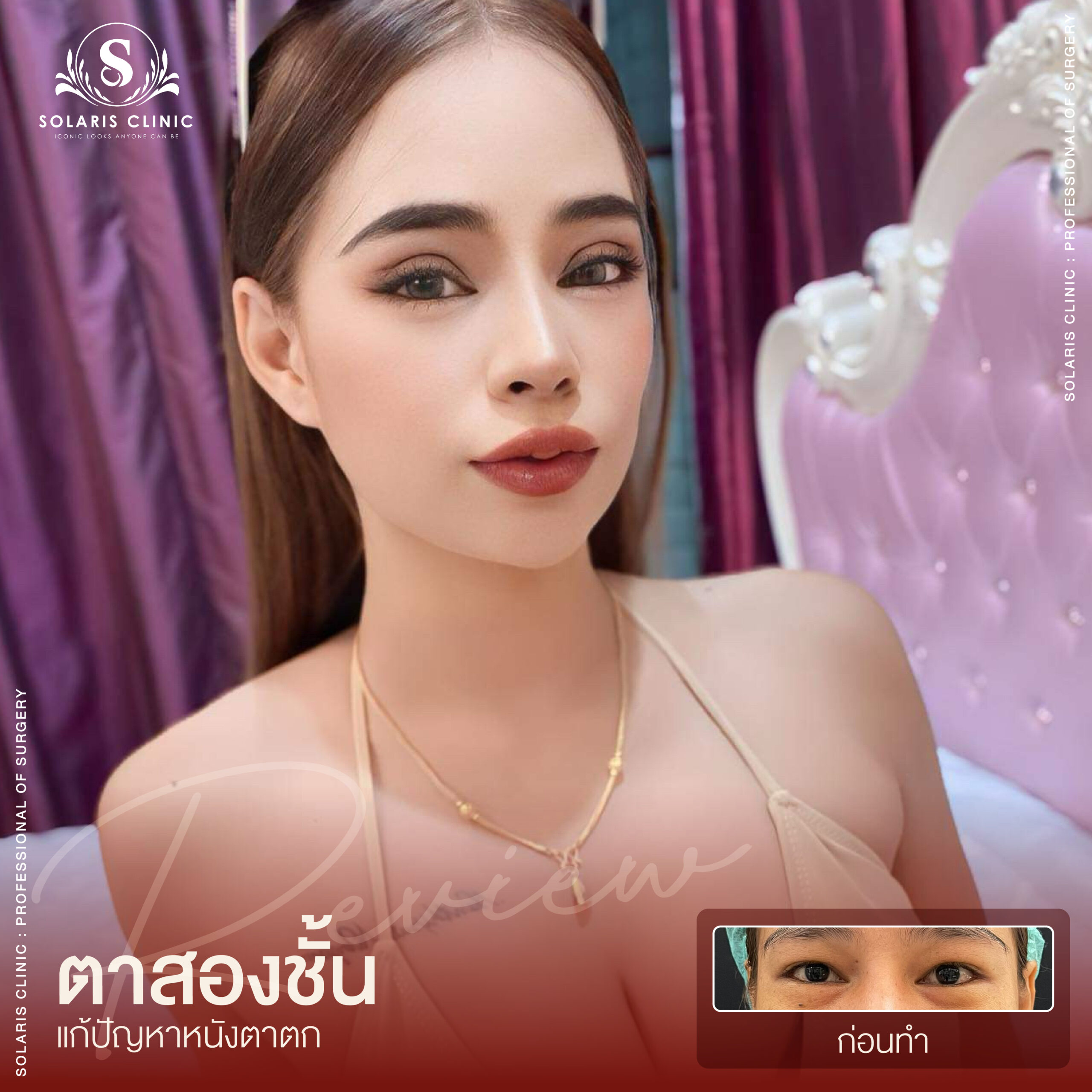 รีวิวหนังตาตก -08