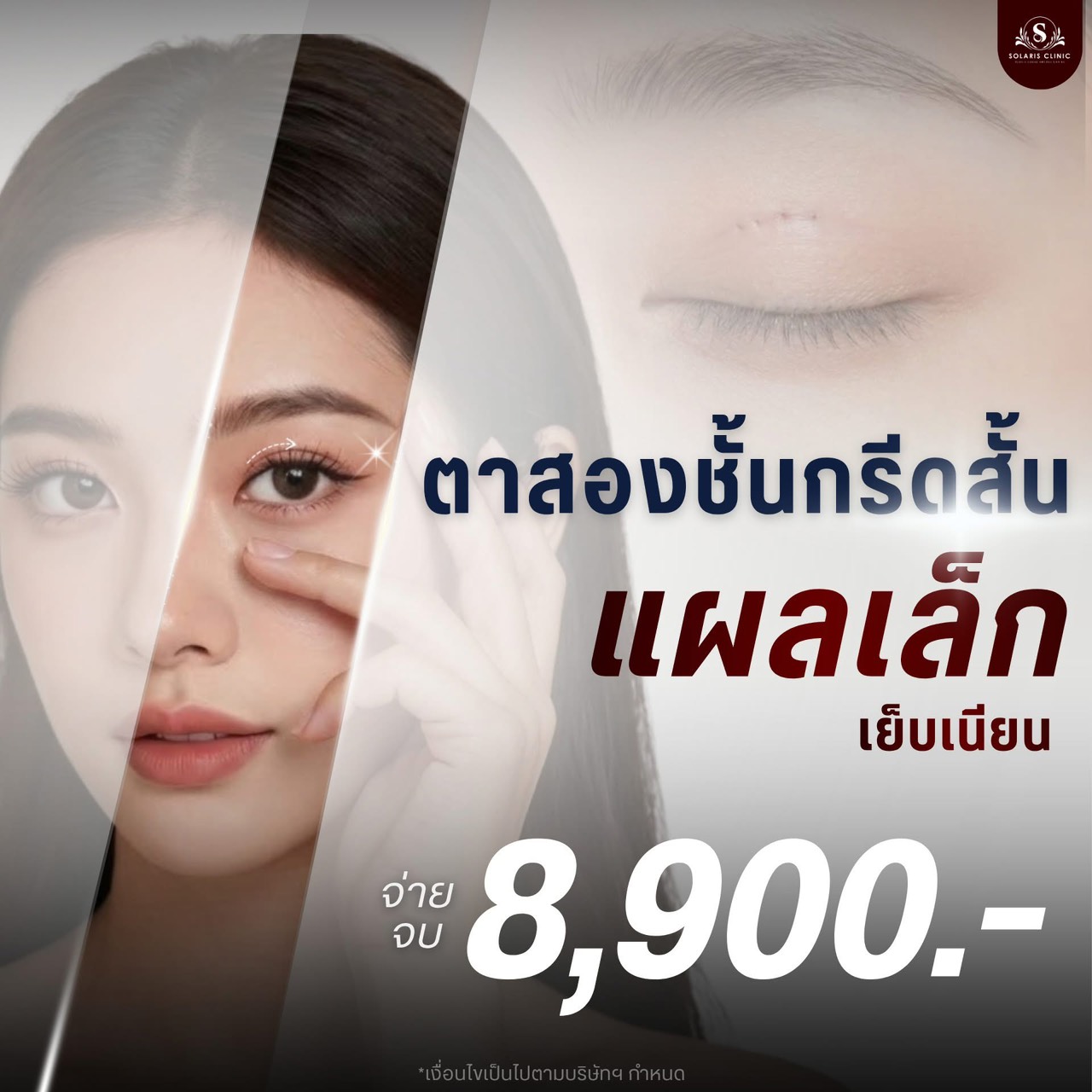 ตาสองชั้นกรีดสั้น