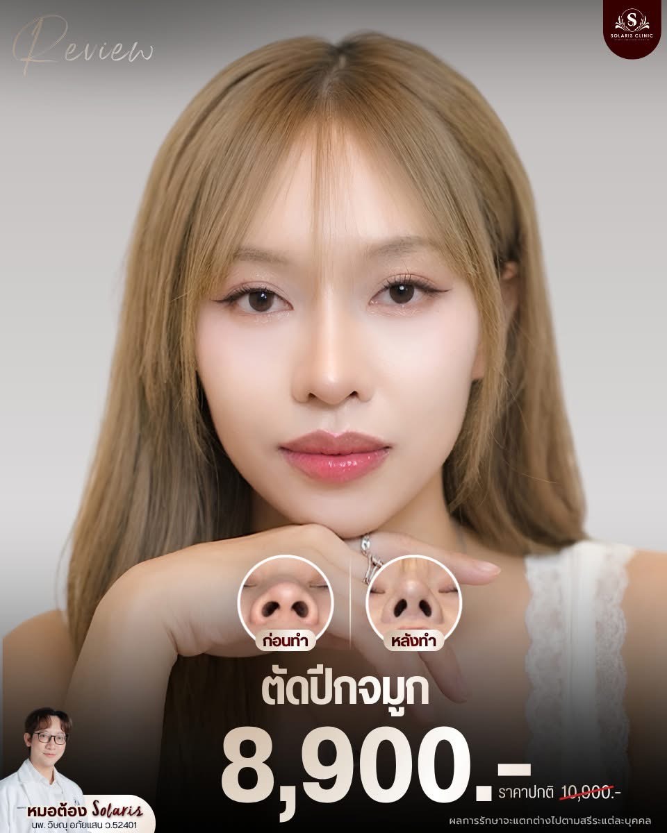ตัดปีกจมูก