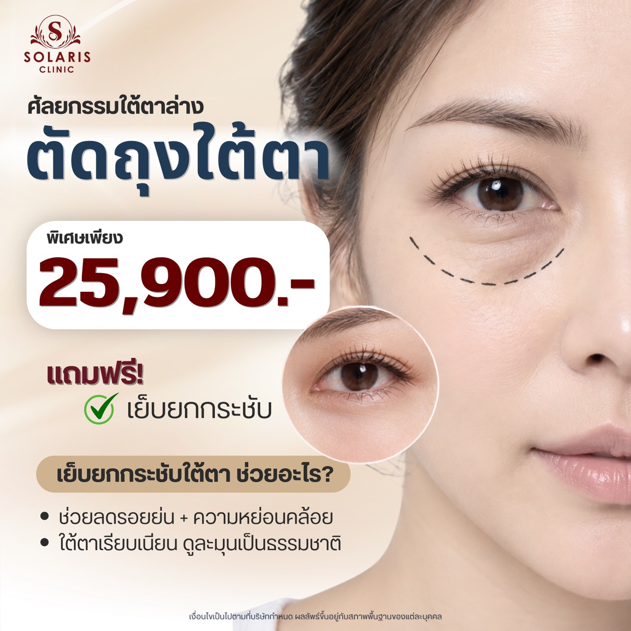 ตัดถุงใต้ตา (ศัลยกรรมใต้ตาล่าง)